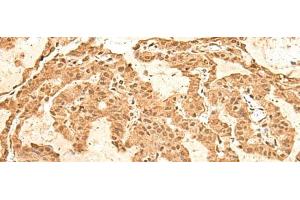 Immunohistochemistry of paraffin-embedded Human thyroid cancer tissue using TIPRL Polyclonal Antibody at dilution of 1:60(x200)