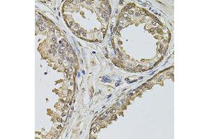 Immunohistochemistry of paraffin-embedded human prostate using CCNA2 antibody (ABIN5975775) at dilution of 1/100 (40x lens). (Cyclin A Antikörper)