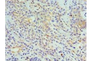 Immunohistochemistry of paraffin-embedded human breast cancer using ABIN7173799 at dilution of 1:100 (TNFSF13 Antikörper  (AA 105-247))