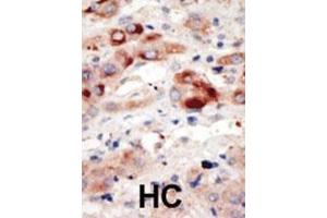 Formalin-fixed and paraffin-embedded human cancer tissue reacted with the primary antibody, which was peroxidase-conjugated to the secondary antibody, followed by DAB staining. (PIK3C3 Antikörper  (N-Term))