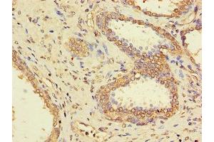 Immunohistochemistry of paraffin-embedded human prostate cancer using ABIN7169312 at dilution of 1:100 (PPP1CC Antikörper  (Catalytic Subunit))