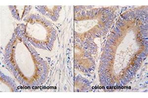 Formalin-fixed and paraffin-embedded human colon carcinoma tissue reacted with GDF11 polyclonal antibody  , which was peroxidase-conjugated to the secondary antibody, followed by DAB staining. (GDF11 Antikörper  (N-Term))
