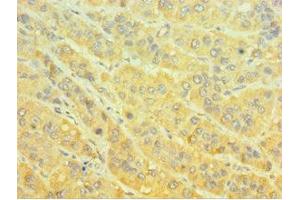 Immunohistochemistry of paraffin-embedded human liver cancer using ABIN7160651 at dilution of 1:100 (MTMR4 Antikörper  (AA 570-820))