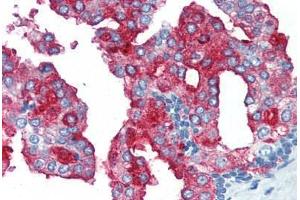 Human Prostate (formalin-fixed, paraffin-embedded) stained with FOLH1 antibody ABIN364431 at 10 ug/ml followed by biotinylated anti-mouse IgG secondary antibody ABIN481714, alkaline phosphatase-streptavidin and chromogen. (PSMA Antikörper)