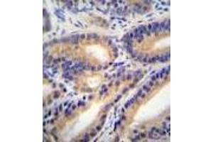HSD11B1L Antibody : immunohistochemistry analysis in formalin fixed and paraffin embedded human prostate carcinoma followed by peroxidase conjugation of the secondary antibody and DAB staining. (HSD11B1L Antikörper  (C-Term))