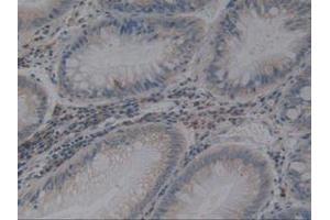 IHC-P analysis of Human Rectum Cancer Tissue, with DAB staining. (Angiotensin I Converting Enzyme 1 Antikörper  (AA 1160-1306))
