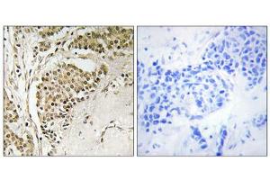 Immunohistochemistry analysis of paraffin-embedded human breast carcinoma tissue using NOM1 antibody. (NOM1 Antikörper  (C-Term))