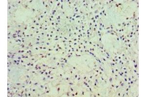 Immunohistochemistry of paraffin-embedded human breast cancer using ABIN7162919 at dilution of 1:100 (Periostin Antikörper  (AA 557-836))
