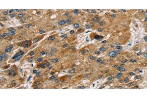 Immunohistochemistry of paraffin-embedded Human liver cancer using SULT1B1 Polyclonal Antibody at dilution of 1:30 (SULT1B1 Antikörper)