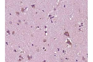 Paraformaldehyde-fixed, paraffin embedded human brain glioma; Antigen retrieval by boiling in sodium citrate buffer (pH6) for 15min; Block endogenous peroxidase by 3% hydrogen peroxide for 30 minutes; Blocking buffer (normal goat serum) at 37°C for 20min; Antibody incubation with YKL39/CHI3L2 Polyclonal Antibody, Unconjugated (bs-1238R) at 1:200 overnight at 4°C, followed by a conjugated secondary and DAB staining. (CHI3L2 Antikörper  (AA 121-220))