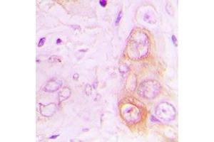 Immunohistochemical analysis of RAB20 staining in human lung cancer formalin fixed paraffin embedded tissue section. (RAB20 Antikörper  (Center))
