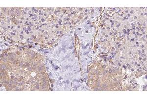 ABIN6273337 at 1/100 staining Human thyroid cancer tissue by IHC-P. (UBE2E2 Antikörper  (N-Term))