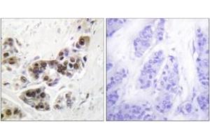 Immunohistochemistry analysis of paraffin-embedded human lung carcinoma tissue, using p53 (Ab-382) Antibody. (p53 Antikörper  (AA 344-393))