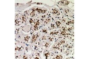 Immunohistochemical analysis of CREB (pS129) staining in human breast cancer formalin fixed paraffin embedded tissue section. (CREB1 Antikörper  (pSer129))
