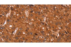 Immunohistochemistry of paraffin-embedded Human liver cancer tissue using Cyclin D3 Polyclonal Antibody at dilution 1:40 (Cyclin D3 Antikörper)