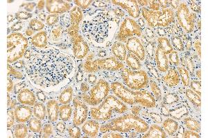 ABIN6261230 and ABIN6277319 at 1/100 staining Human kidney cancer and adjacent normal tissues by IHC-P. (DBH Antikörper  (Internal Region))