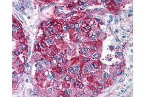 Anti-NPY5R antibody IHC of human Lung, Adenocarcinoma. (NPY5R Antikörper  (Cytoplasmic Domain))