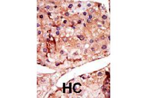 Formalin-fixed and paraffin-embedded human hepatocellular carcinoma tissue reacted with PFKFB2 polyclonal antibody  , which was peroxidase-conjugated to the secondary antibody, followed by DAB staining.