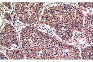 Immunohistochemistry of paraffin-embedded Human lung carcinoma tissue using Phospho-AKT1 (Ser473) Monoclonal Antibody at dilution of 1:200 (AKT1 Antikörper  (pSer473))