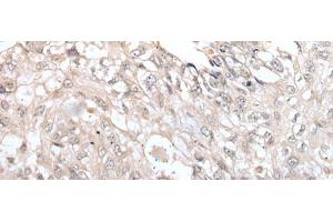 Immunohistochemistry of paraffin-embedded Human lung cancer tissue using VRK3 Polyclonal Antibody at dilution of 1:45(x200) (VRK3 Antikörper)
