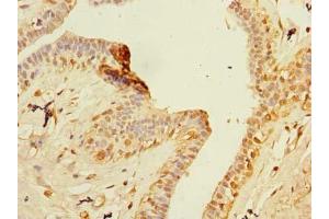 Immunohistochemistry of paraffin-embedded human breast cancer using ABIN7176473 at dilution of 1:100 (ZNF726P1 Antikörper  (AA 1-389))