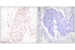 Immunohistochemistry analysis of paraffin-embedded human breast carcinoma tissue using SENP8 antibody. (SENP8 Antikörper  (C-Term))