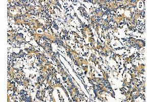 ABIN7095406 and ABIN7099463 at 1/100 staining human colorectal cancer by IHC-P. (XIRP2 Antikörper)