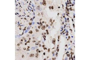 Immunohistochemistry of paraffin-embedded human lung cancer using DiMethyl-Histone H3-K27 antibody. (Histone 3 Antikörper  (H3K27me))