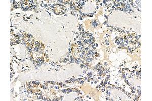 ABIN7096751 and ABIN7100816 at 1/100 staining human ovarian cancer by IHC-P.