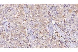 ABIN6273332 at 1/100 staining Human thyroid cancer tissue by IHC-P. (Transmembrane Protein 70 (TMM70) (Internal Region) Antikörper)