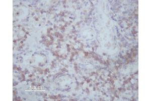 ABIN6266591 at 1/200 staining human Oral squamous cell carcinoma sections by IHC-P. (MMP14 Antikörper  (C-Term))