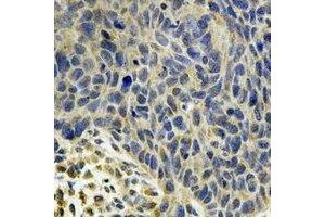 Immunohistochemical analysis of MsrB2 staining in human esophageal cancer formalin fixed paraffin embedded tissue section.