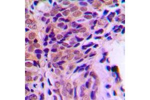 Immunohistochemical analysis of Glucocorticoid Receptor (pS211) staining in human prostate cancer formalin fixed paraffin embedded tissue section. (Glucocorticoid Receptor Antikörper  (pSer211))