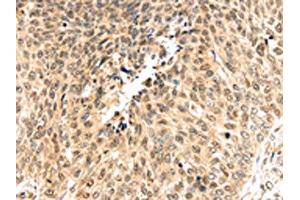 The image on the left is immunohistochemistry of paraffin-embedded Human lung cancer tissue using ABIN7192036(PSMB8 Antibody) at dilution 1/30, on the right is treated with synthetic peptide. (PSMB8 Antikörper)