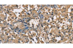 Immunohistochemistry of paraffin-embedded Human thyroid cancer using ENO1 Polyclonal Antibody at dilution of 1:60 (ENO1 Antikörper)