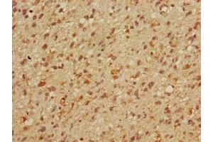 Immunohistochemistry of paraffin-embedded human glioma using ABIN7159613 at dilution of 1:100 (MBD3 Antikörper  (AA 79-209))