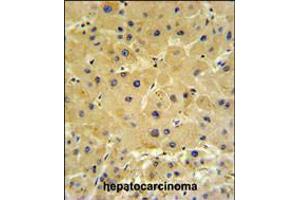 IFT20 Antibody IHC analysis in formalin fixed and paraffin embedded hepatocarcinoma followed by peroxidase conjugation of the secondary antibody and DAB staining. (IFT20 Antikörper  (AA 44-71))