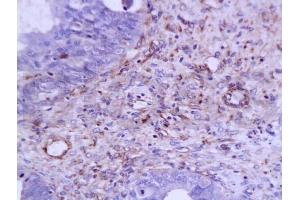 Formalin-fixed and paraffin embedded: human ovary carcinoma labeled with Anti-VEGF Polyclonal Antibody, Unconjugated (ABIN727205) at 1:200, followed by conjugation to the secondary antibody and DAB staining (VEGF Antikörper  (AA 27-120))