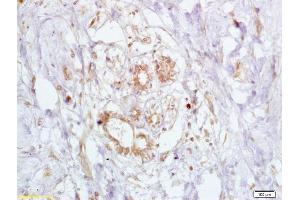 Formalin-fixed and paraffin embedded human breast carcinoma labeled Anti-BRCA2 Polyclonal Antibody, Unconjugated (ABIN673434) at 1:200, followed by conjugation to the secondary antibody and DAB staining (BRCA2 Antikörper  (AA 21-130))