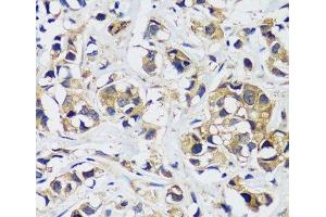Immunohistochemistry of paraffin-embedded Human breast cancer using CAMLG Polyclonal Antibody at dilution of 1:100 (40x lens). (CAMLG Antikörper)