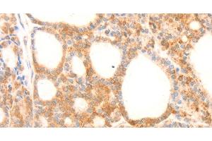 Immunohistochemistry of paraffin-embedded Human thyroid cancer using NAP1L1 Polyclonal Antibody at dilution of 1:70