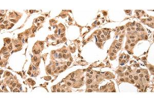 Immunohistochemistry of paraffin-embedded Human breast cancer using ACO2 Polyclonal Antibody at dilution of 1:30 (ACO2 Antikörper)