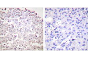 Peptide - +Immunohistochemical analysis of paraffin-embedded human breast carcinoma tissue using GADD153 antibody (#C0202). (DDIT3 Antikörper)