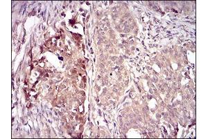 Immunohistochemical analysis of paraffin-embedded cervical cancer tissues using VIL1 mouse mAb with DAB staining. (Villin 1 Antikörper  (AA 1-209))