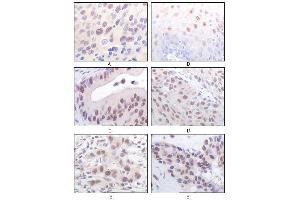 Immunohistochemical analysis of paraffin-embedded human esophageal squamous cell carcinoma (A), normal esophagus epithelium (B), rectum adenocarcinoma (C), lung squamous cell carcinoma (D), breast infiltrating carcinoma (E), and breast infiltrating carcinoma (F) tissues, showing nuclear localization using MOF/MYST1 mouse mAb with DAB staining. (MYST1 Antikörper)