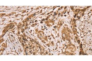 Immunohistochemistry of paraffin-embedded Human esophagus cancer using HIF1AN Polyclonal Antibody at dilution of 1:40 (HIF1AN Antikörper)