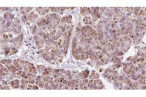 ABIN6273249 at 1/100 staining Human pancreas cancer tissue by IHC-P. (GMFG Antikörper  (Internal Region))