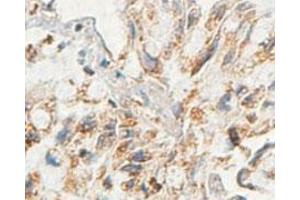 Immunohistochemical analysis of paraffin-embedded human lung carcinoma showing cytoplasmic staining with AARSD1 polyclonal antibody  at a 1 : 100 dilution. (AARSD1 Antikörper  (AA 278-522))