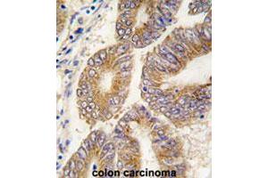 Formalin-fixed and paraffin-embedded human colon carcinomareacted with AHCY polyclonal antibody , which was peroxidase-conjugated to the secondary antibody, followed by AEC staining. (AHCY Antikörper  (C-Term))