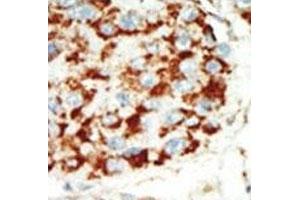 IHC analysis of FFPE human hepatocarcinoma tissue stained with the AMPK beta 1 antibody (PRKAB1 Antikörper  (AA 4-34))